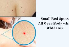 Red Spots on skin All Over Body
