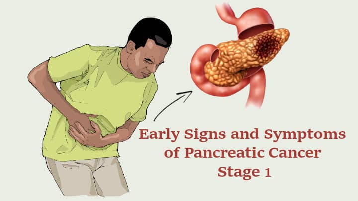 Early Signs and Symptoms of Pancreatic Cancer Stage 1