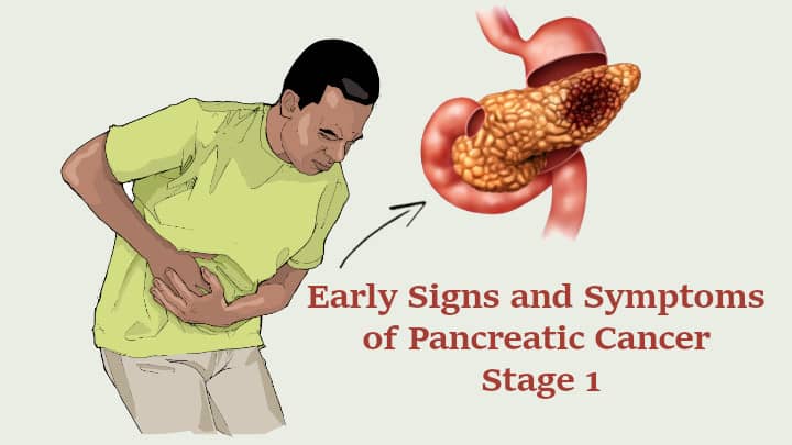 11 Early Signs And Symptoms Of Pancreatic Cancer Stage 1