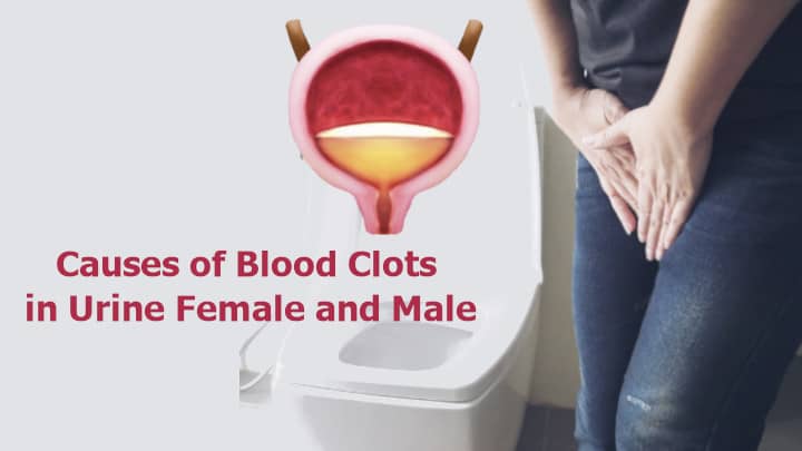 What Causes Blood Clots in Urine Female