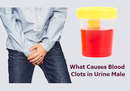 What Causes Blood Clots in Urine Male