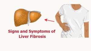 Fibrosis of the Liver: 11 Signs and Symptoms of Liver Fibrosis