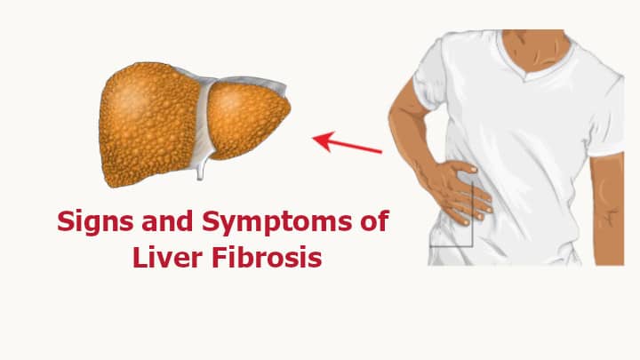 Signs and Symptoms of Liver Fibrosis
