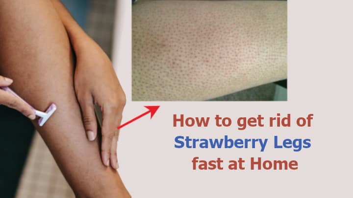 how to get rid of Strawberry Legs fast