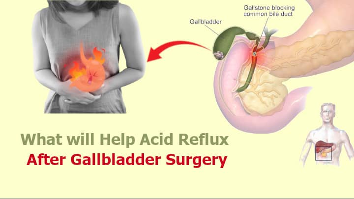 What will Help Acid Reflux After Gallbladder Surgery