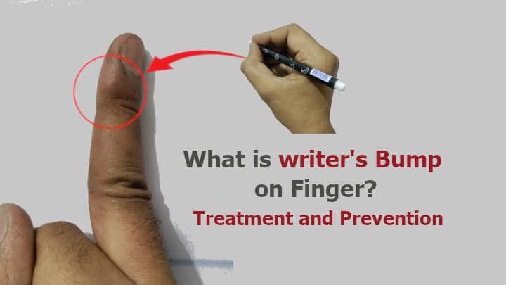 what-is-writer-s-bump-on-finger-treatment-and-prevention