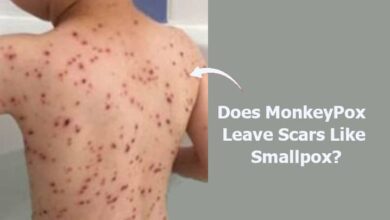 Does MonkeyPox Leave Scars