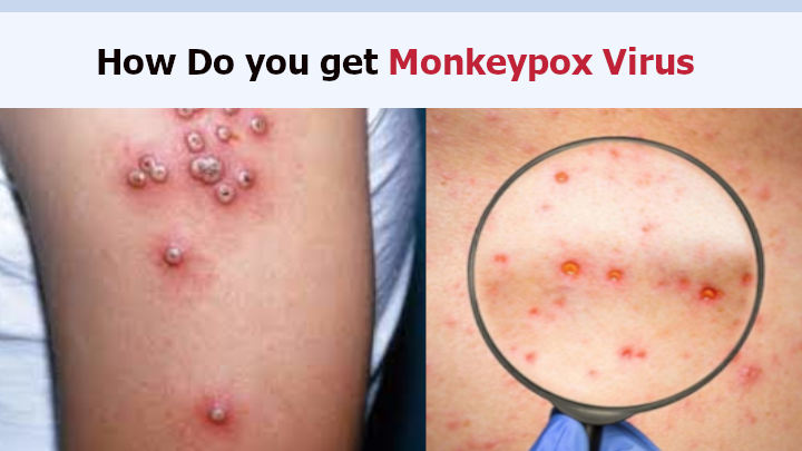 How Do you get Monkeypox Virus Disease