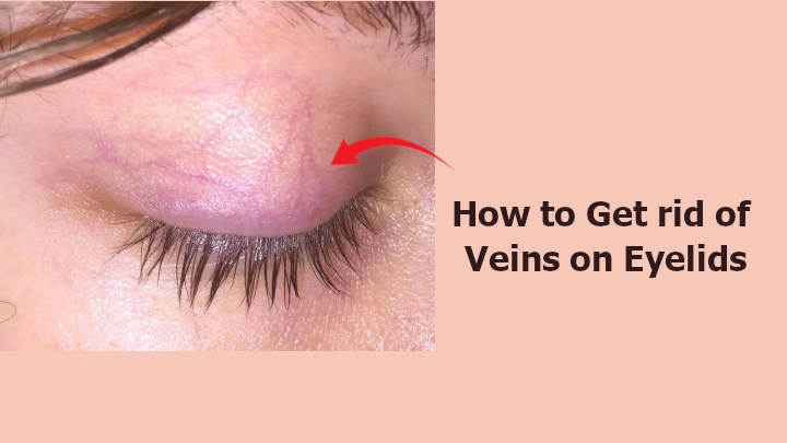 How to Get rid of Veins on Eyelids