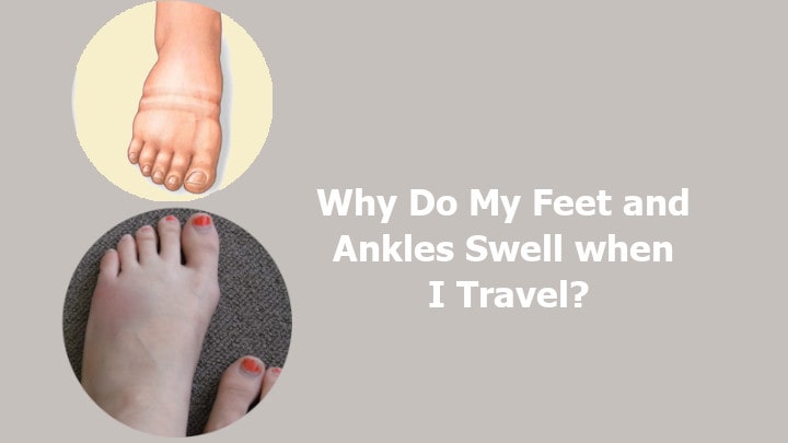 Why Do My Feet and Ankles Swell when i Travel