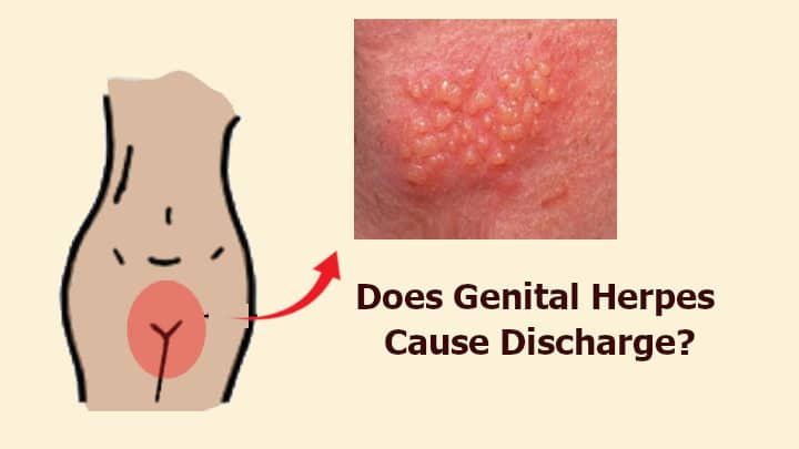 Does Genital Herpes Cause Discharge