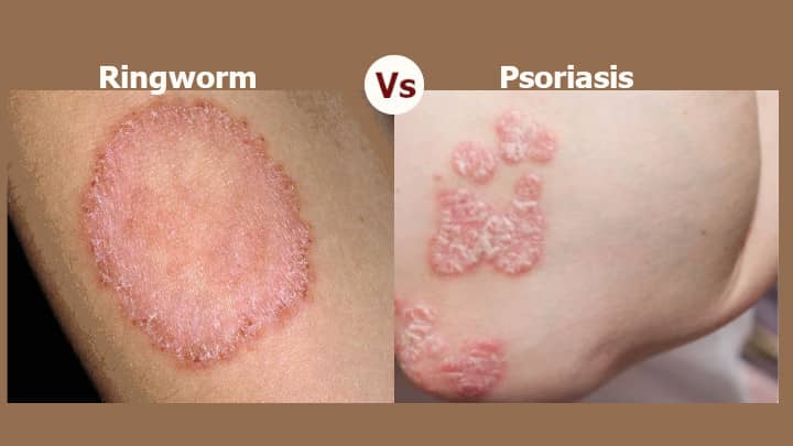 Ringworm vs Psoriasis