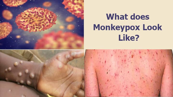 What does Monkeypox Look Like