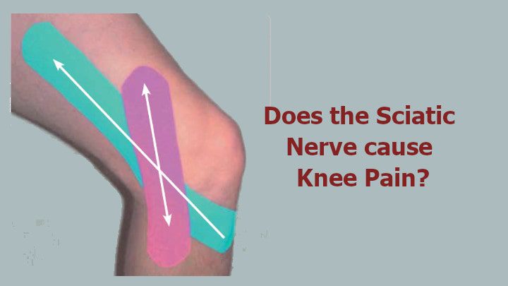 does-the-sciatic-nerve-cause-knee-pain