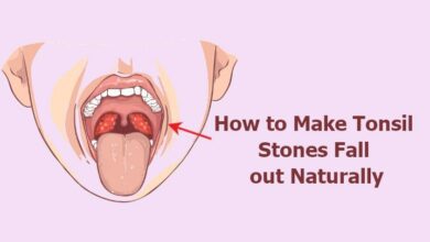 How to Make Tonsil Stones Fall out Naturally