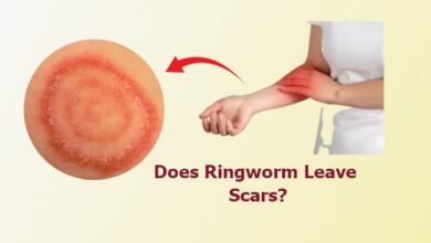 Does Ringworm Leave Scars