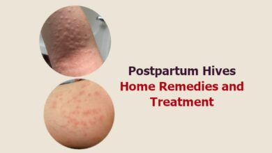 Postpartum Hives Home Remedies