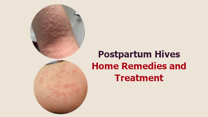 Postpartum Hives Home Remedies