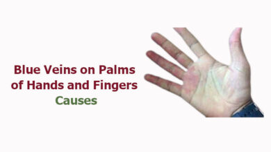 Blue Veins on Palms of Hands