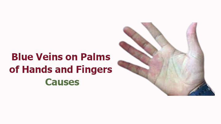 Blue Veins on Palms of Hands