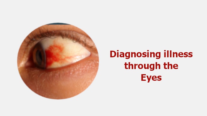 Diagnosing illness through the Eyes