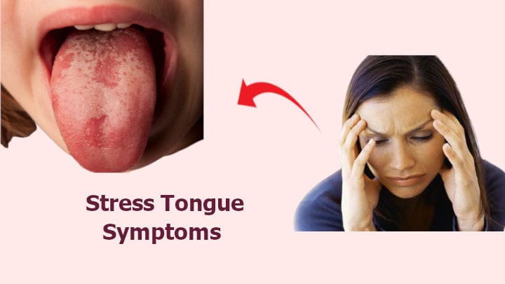 Stress Tongue Symptoms