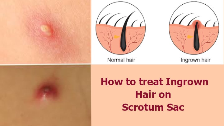 ingrown hair scrotum