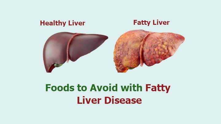 Foods to Avoid with Fatty Liver Disease