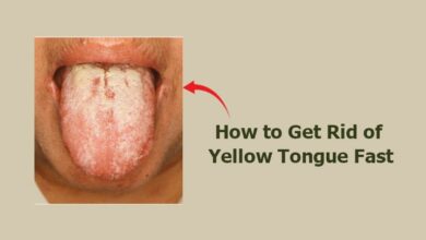 How to Get Rid of Yellow Tongue Fast