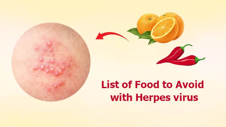 Food to Avoid with Herpes virus