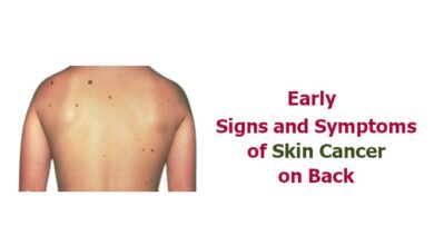 Signs of Skin Cancer on Back