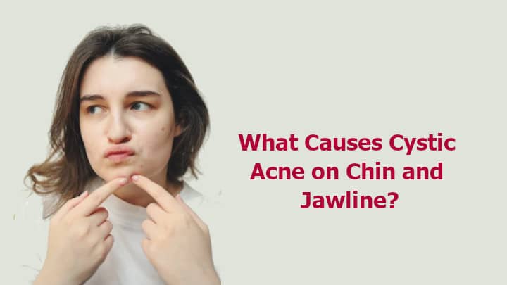 What Causes Cystic Acne on Chin and Jawline