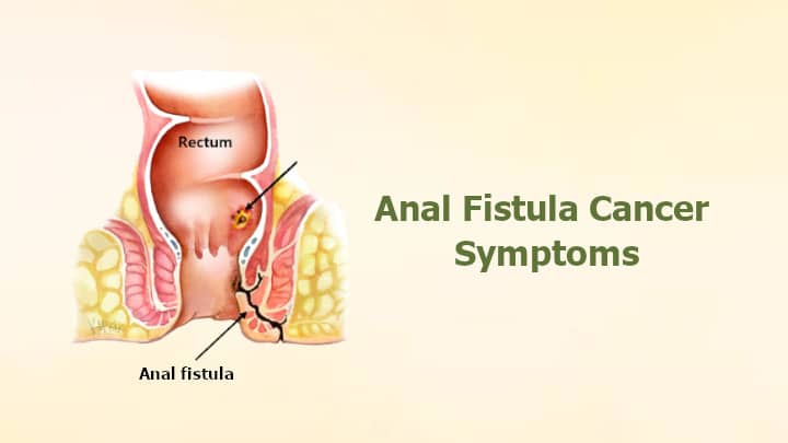 Anal Fistula Cancer Symptoms