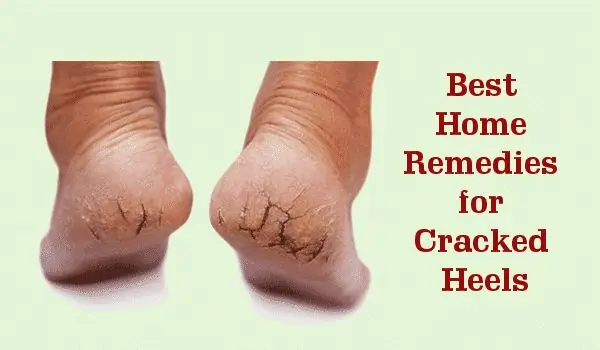 Home Remedies for Cracked Heels