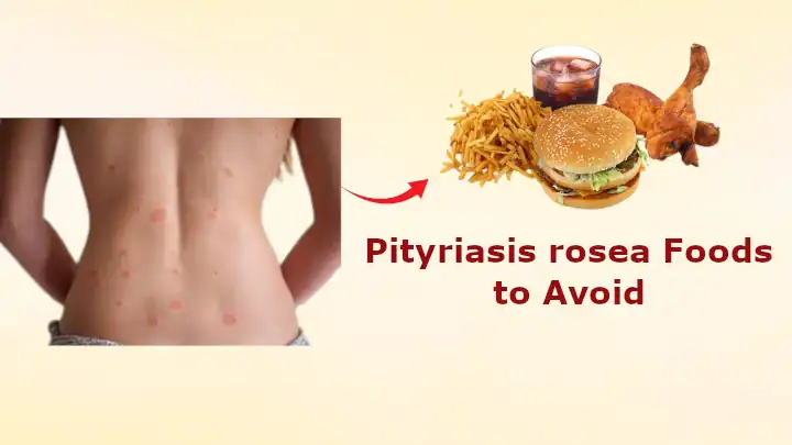 Pityriasis rosea Foods to Avoid