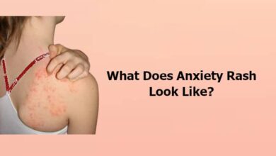 What Does Anxiety Rash Look Like