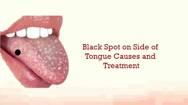 Black Spot on Side of Tongue