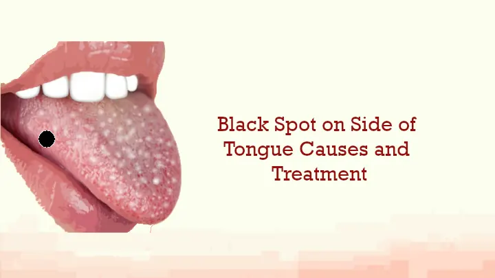 Black Spot On Side Of Tongue.webp