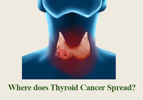 Where does Thyroid Cancer Spread to