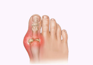 Gout Pain in Heel: Heel Pain Gout Symptoms and Treatment