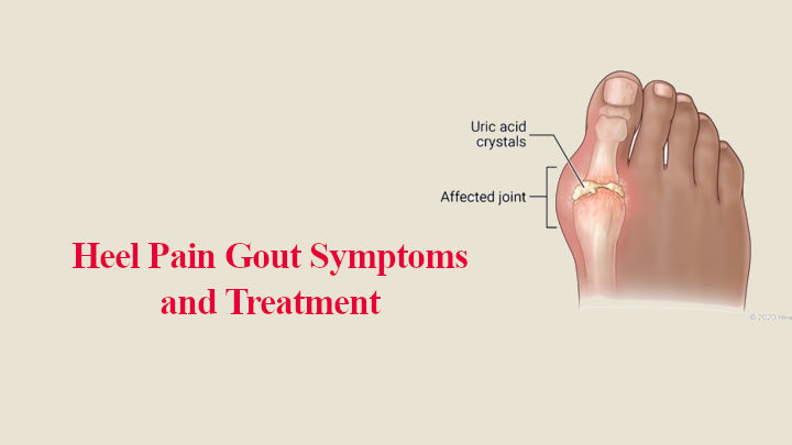 Heel Pain Gout Symptoms