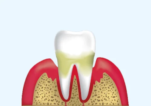 Foods to Avoid with gum Infection