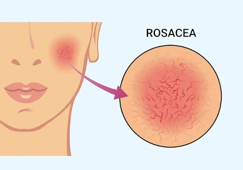 Good and Bad Foods for Rosacea