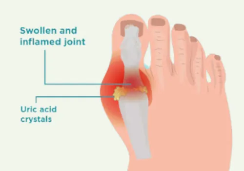 Common Causes of High Uric Acid Level