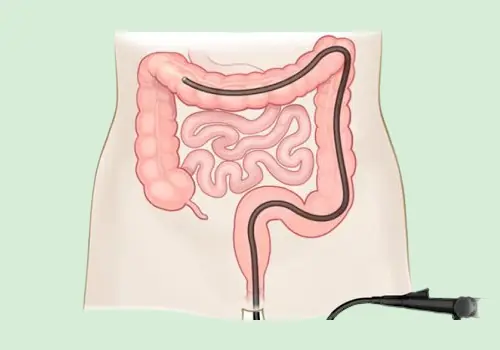 Foods to Eat After Colonoscopy