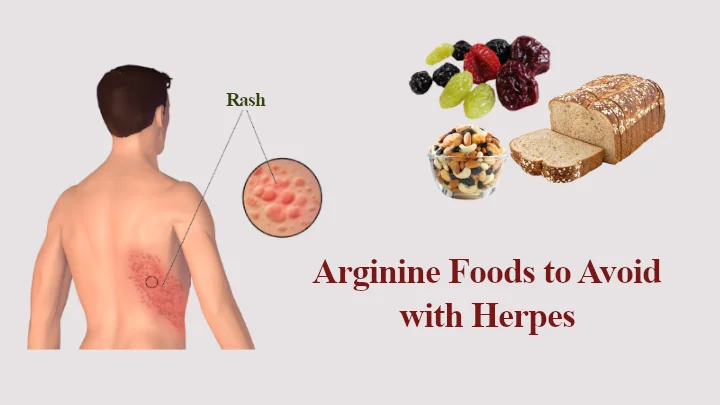 Arginine Foods to Avoid with Herpes