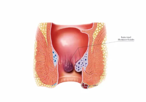 Food not to Eat After Hemorrhoid Surgery