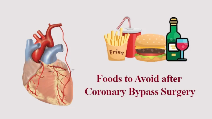 Foods to Avoid after Coronary Bypass Surgery