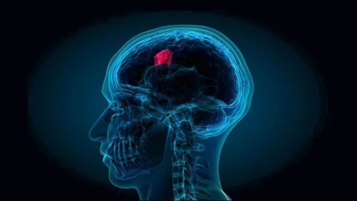 Connection Between Brain Injury and Brain Cancer