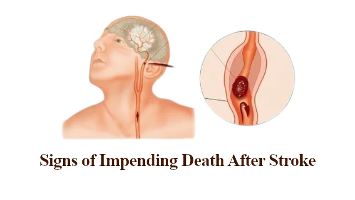 Signs of Impending Death After Stroke